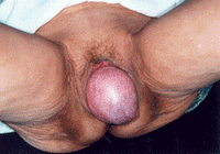prolaps uteri ( kandungan turun )